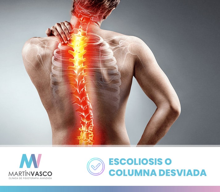 Escoliosis o Columna desviada - Fisioterapia Talavera Martín Vasco